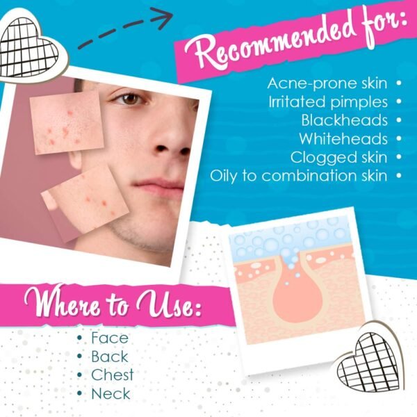 Bye Bye Blemish Acne Drying Lotion, Reduce Pimples Overnight 1oz, 1-Pack - Image 5