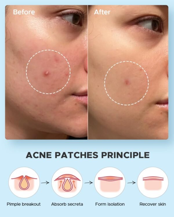 LitBear Acne Pimple Patches- Day and Night 4 Sizes 180 Dots Thin & Thick Hydrocolloid Patches with Witch Hazel, Tea Tree & Calendula Oil, Extra Adhesion for Face Zit Patch Dots - Image 7
