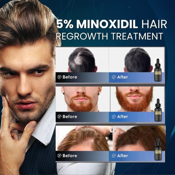 5% Minoxidil Hair Growth for Men and Women: Biotin Hair Growth Serum for Hair Loss, Thinning, and Faster Regrowth Treatment - 60ML - Image 3