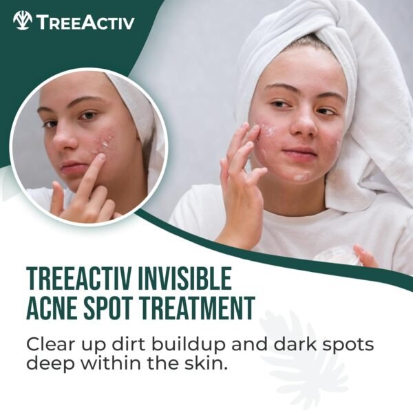 TreeActiv Invisible Salicylic Acid Cystic Acne Treatment For Face Original Formula, 0.5 fl oz, Acne Face Cream, Acne Spot Treatment for Face & Body, Acne Clearing Cream Moisturizer for Teens & Adults - Image 3