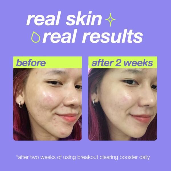 Dermalogica Clear Start Breakout Clearing Booster (1 Fl Oz) Acne Spot Treatment with Salicylic Acid - Clears Breakouts & Locks in Moisture To Soothe Irritation - Image 6
