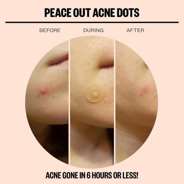 Peace Out Skincare Acne Dots, Hydrocolloid Pimple Patches Help Clear Blemishes Overnight, Award Winning Fast Acting Anti-Acne Solution (20 dots) - Image 5