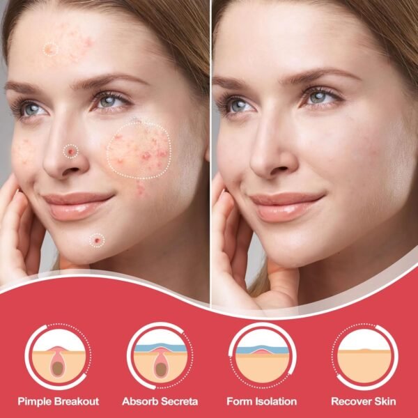216 Counts Pimple Patches for Face, Hydrocolloid Acne Patches Zit Patches for Face Acne Spot Treatment Patch Cystic Acne Treatment Stickers Blemish Hydrocolloid Patches for all Skin Type - Image 3