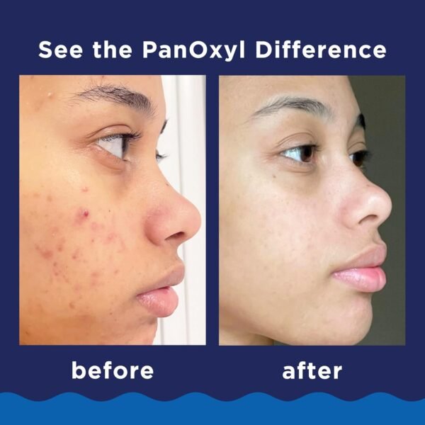 PanOxyl Acne Foaming Wash Benzoyl Peroxide 10% Maximum Strength Antimicrobial, 5.5 Oz - Image 6