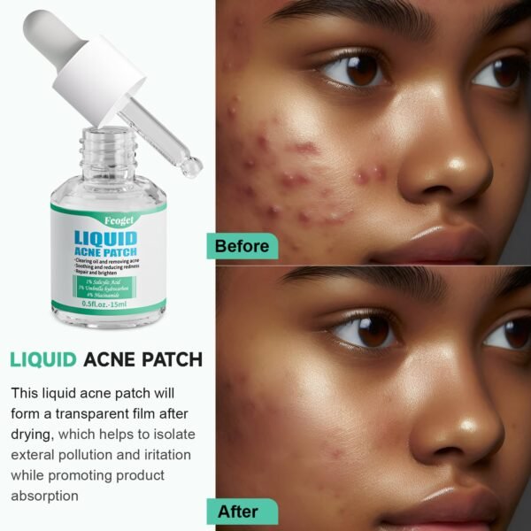 Acne Spot Treatment Serum for Face, with 2% Salicylic Acid & 4% Niacinamide Face Serum, Liquid Pimple Patch for Acne Prone Skin, Soothing Redness, Clearing Oil Skin Care for Teens & Adults - Image 3