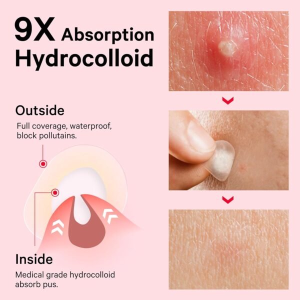 Sosky Pimple Patches for Face, FSA HSA Eligible Invisible Hydrocolloid Acne Patches, Zit Sticker for Face and Skin, Pimple Patches for Covering Zits, Blemishes with Salicylic Acid 48 Count - Image 4