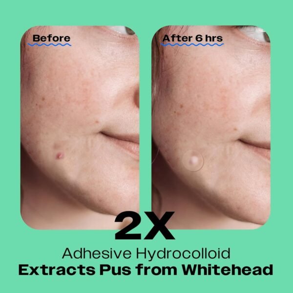 Avarelle Acne Pimple Patch (40 Count) Absorbing Hydrocolloid Spot Treatment with Tea Tree Oil, Calendula Oil and Cica, Certified Vegan, Cruelty Free (VARIETY / 40 COUNT) - Image 3