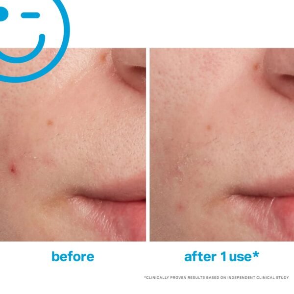 Kate Somerville EradiKate Acne Treatment - Clinically Formulated 10% Sulfur and BHA Spot Treatment – Clears Pimples, Cleans Pores and Prevents Breakouts, 1 Fl Oz - Image 7
