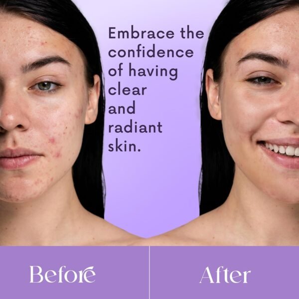 NXN Acne Edit Spot Treatment with Probiotics, Licorice Root, Ginger and Colloidal Sulfur, to rapidly reduce acne blemish size - Image 3
