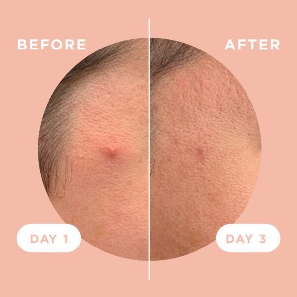 ZitSticka Killa Pimple Patches for Face - World's Most Potent Pimple Patch with Fast-Acting Microdarts - Starts Working within 2 Hours for Deep, Early-Stage Zits - 8 Count - Image 6