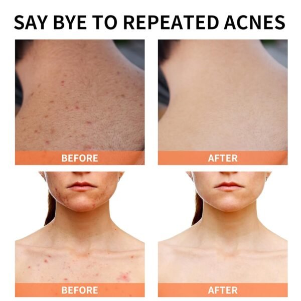 Acne Treatment for Face for Hormonal Cystic Stubborn Acne Cream for Sensitive Skin Teens Adults Women Men Spot Pimple Butt Control Rapid Clearing Breakout Overnight - Image 6