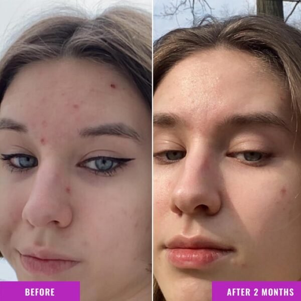 Good Molecules Niacinamide Serum - 10% Niacinamide Balancing B3 Facial Serum for Acne, Tone, Texture - Brightening and Hydrating Skincare for Face - Image 5
