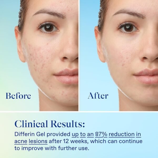 Differin Acne Skin Care Kit, Differin Gel Retinoid Acne Treatment for Face with 0.1% Adapalene & 5% Benzoyl Peroxide Face Wash & Body Wash, Designed for Pimple and Acne Prone Skin - Image 12