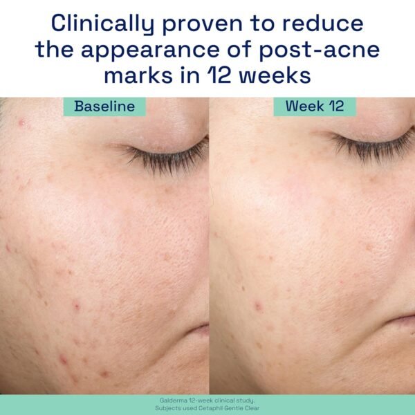 CETAPHIL Gentle Clear Repairing Post-Acne Serum, Retinol Alternative, Oil Free Serum for Sensitive Skin, 1 Fl Oz, Bakuchiol, Improves Skin Tone & Post-acne Marks, Dermatologist Recommended Brand - Image 6